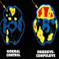 Ocd Brain Vs Normal Brain