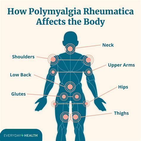 Polymyalgia Blood Cancer